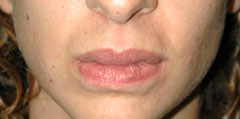 Revision Lip Augmentation - Patient 2 - After
